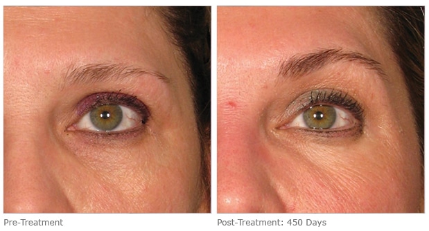 Project Skin Vancouver SkinLift Ultherapy Brow Lift