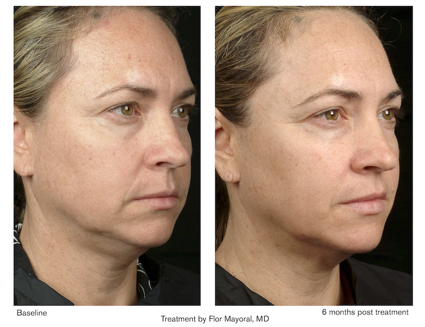 Project-Skin-Vancouver-Thermage-Before-and-After-2-1