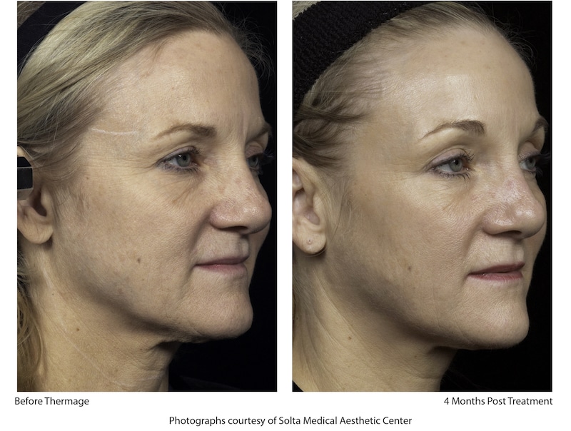 Project-Skin-Vancouver-Thermage-Before-and-After-3