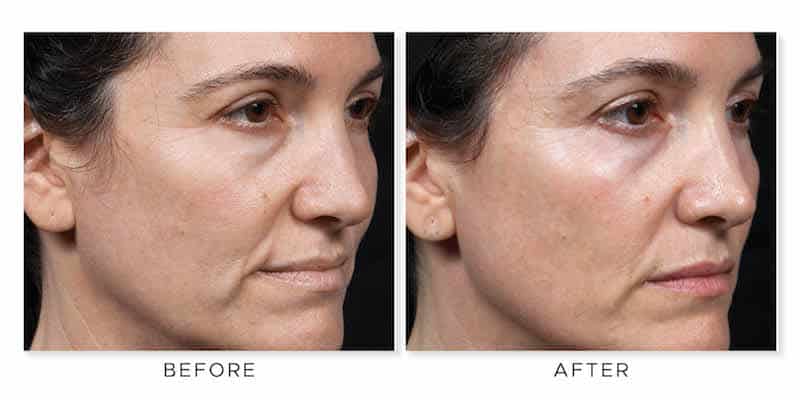 Project-Skin-Vancouver-Thermage-Before-and-After