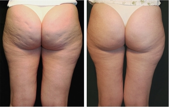 Project Skin Vancouver Thermage Cellulite 1