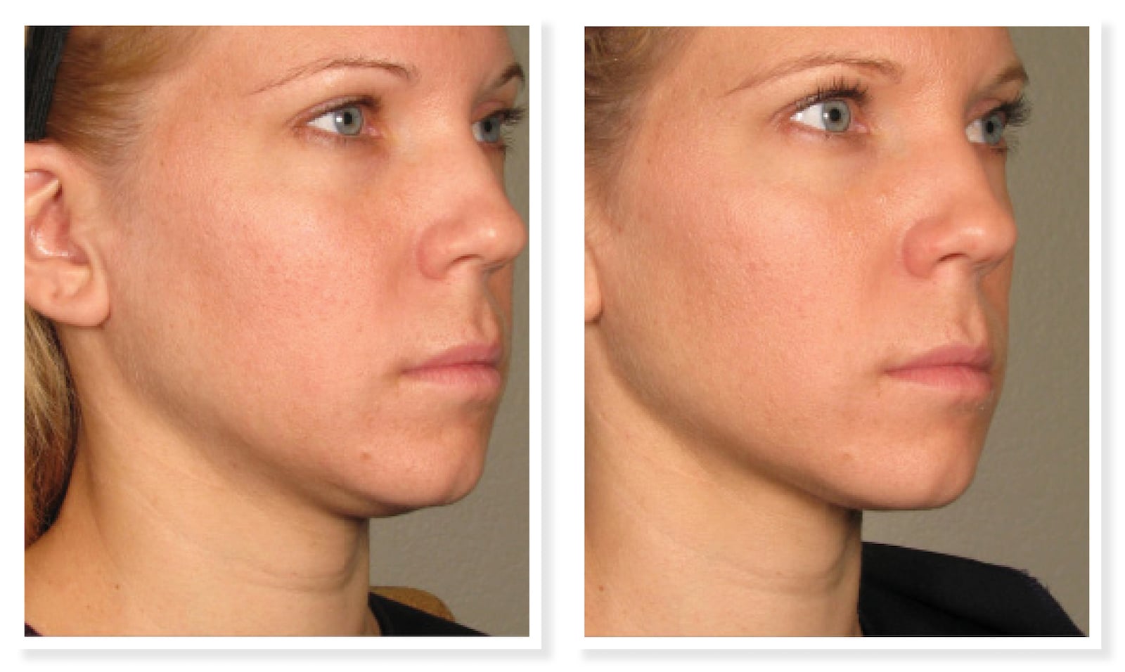 Project Skin Vancouver Ultherapy Before After Jawline 2