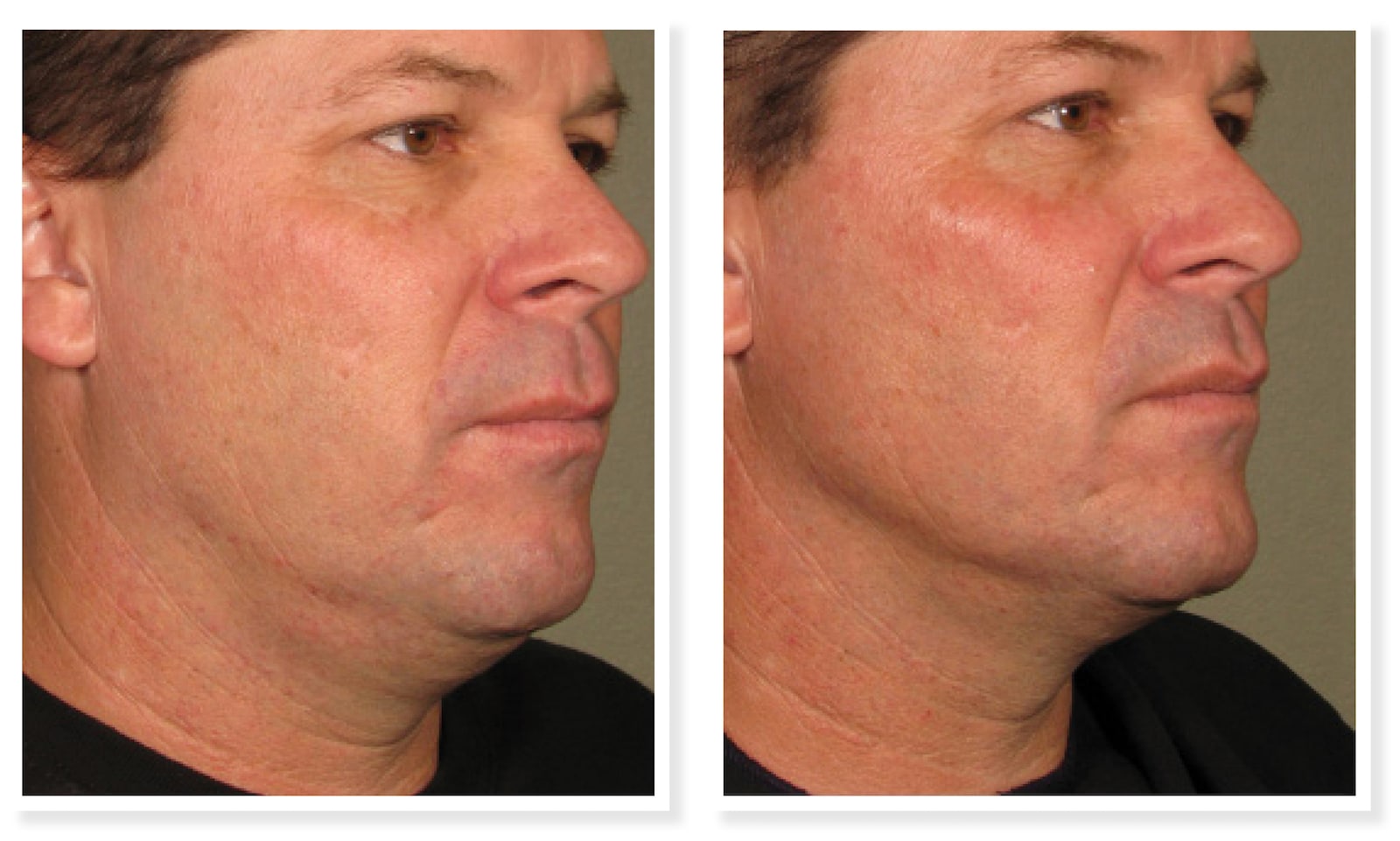 Project Skin Vancouver Ultherapy Before After Jawline
