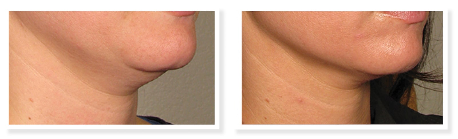 Project Skin Vancouver Ultherapy Before After Neck