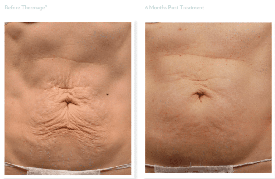 Thermage Body Before & After