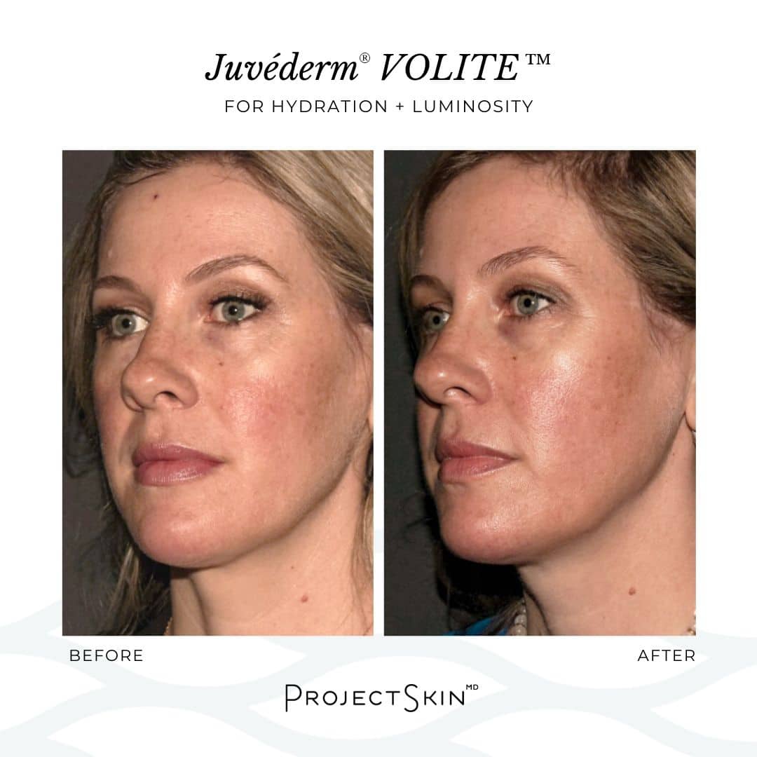 Project Skin MD Volite