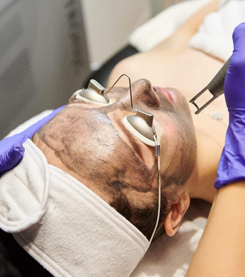 Carbon Laser Peel | Project Skin MD®