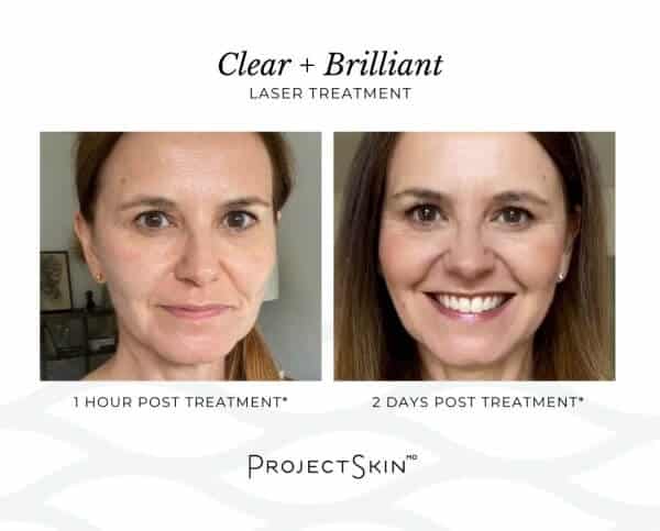 Project Skin MD Clear + Brilliant Kristina Matisic
