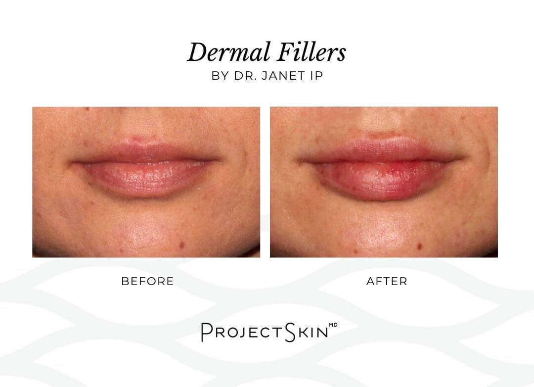 Project Skin MD Dr. Janet Ip Before + After