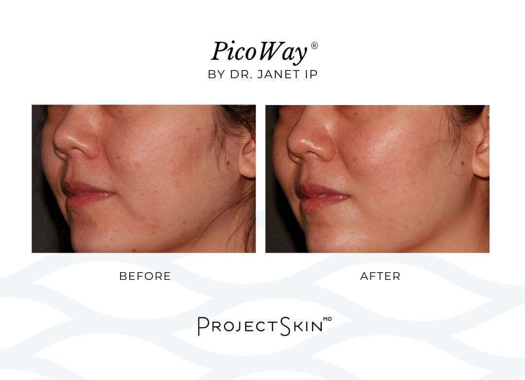 Project Skin MD Dr. Janet Ip Before + After