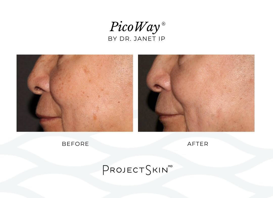 Project Skin MD Dr. Janet Ip Before + After