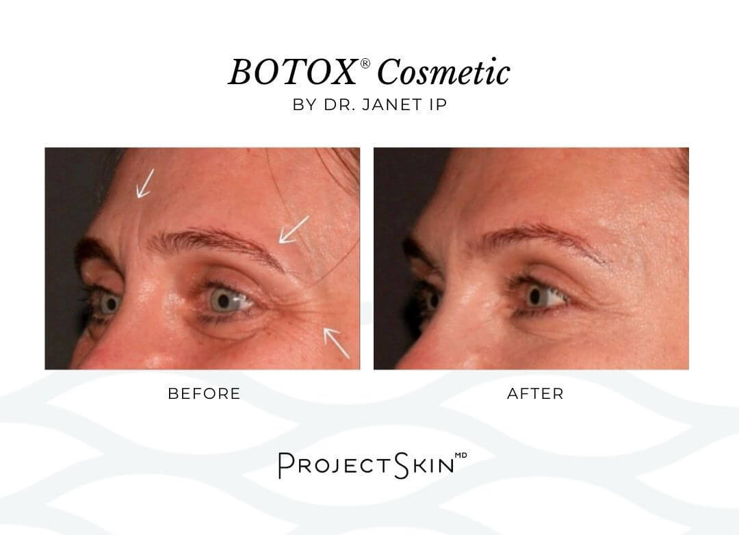 Project Skin MD Dr. Janet Ip Before + After