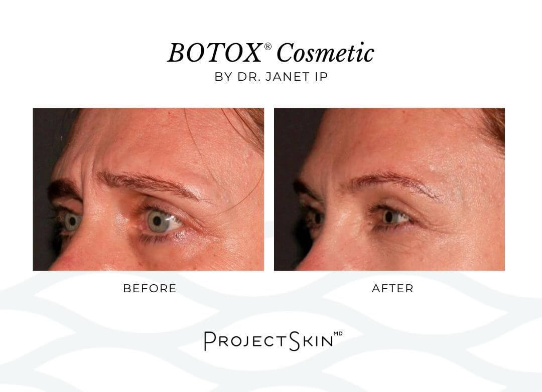 Project Skin MD Dr. Janet Ip Before + After