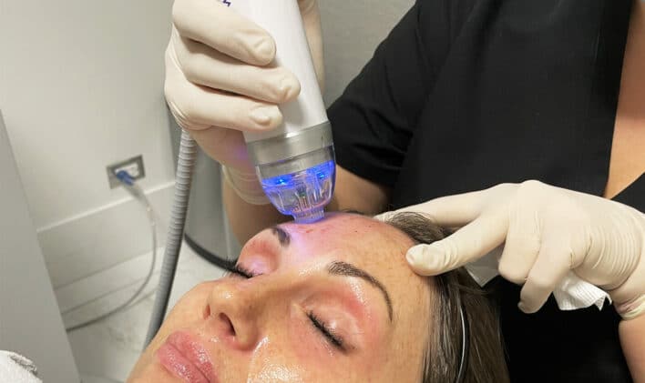 rf_microneedling_treatment_and_technology
