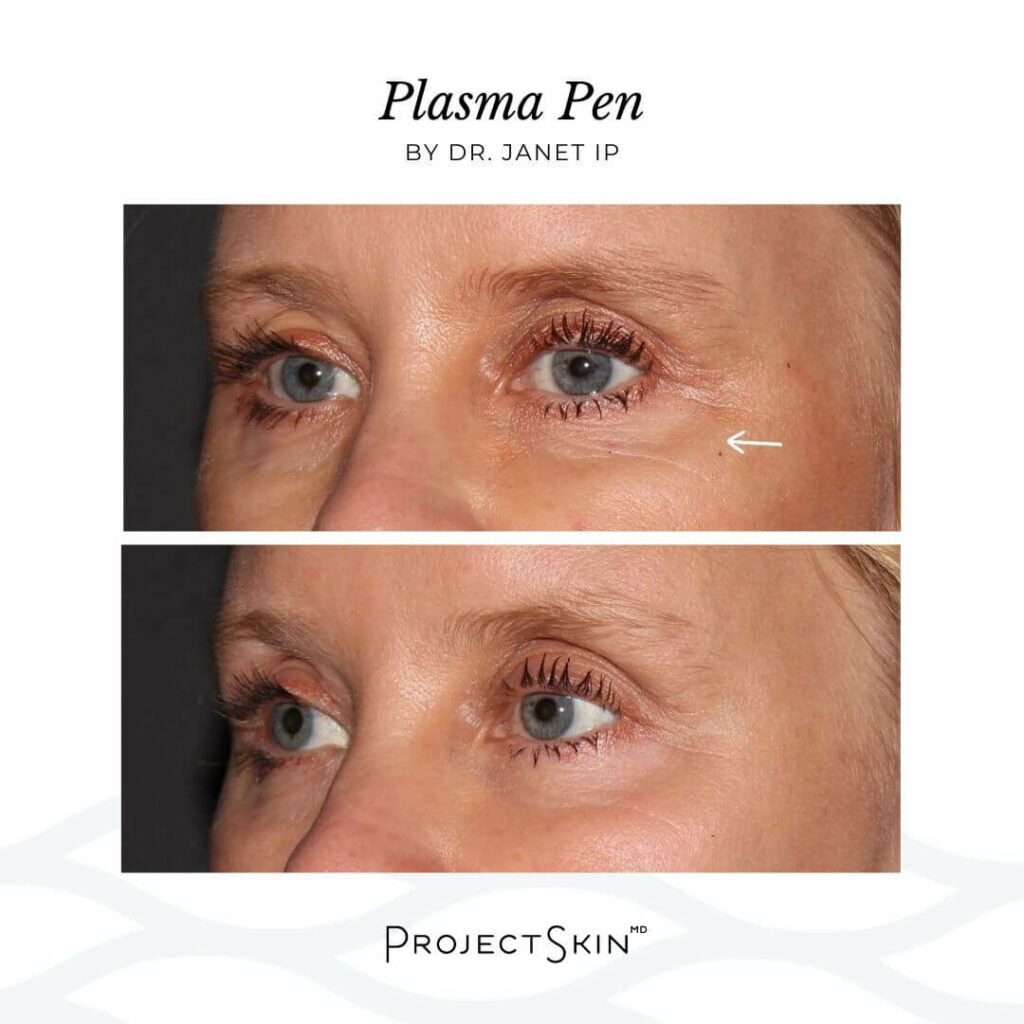 Plasma Pen by Dr. Janet Ip