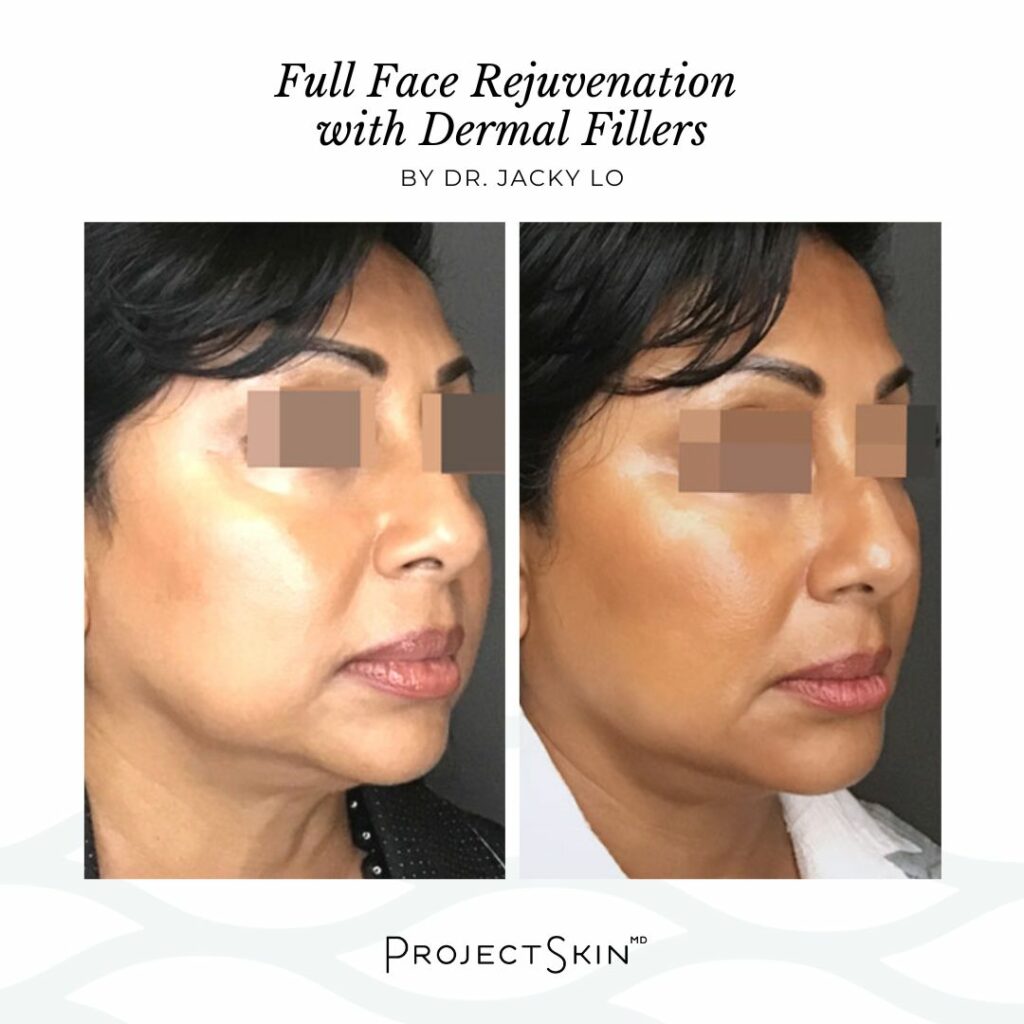 Full face rejuvenation by Dr. Jacky Lo