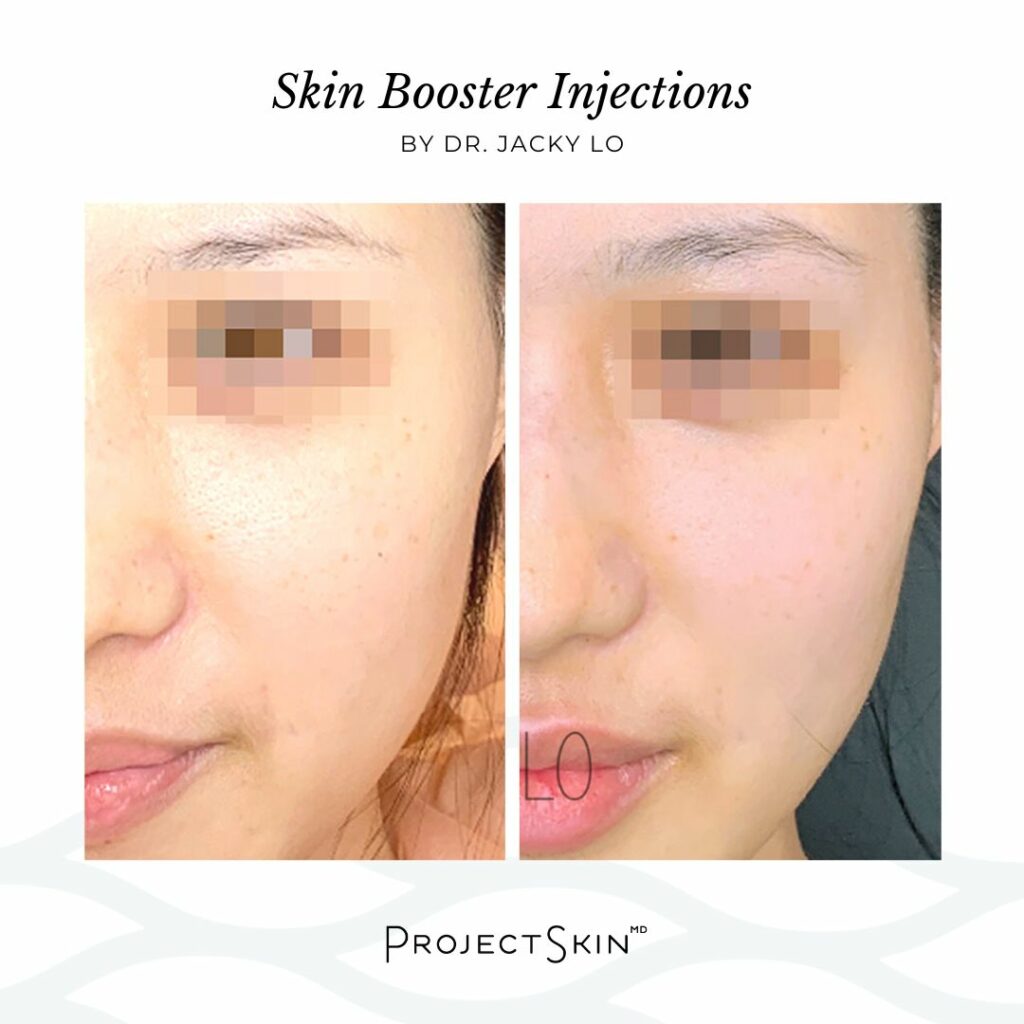 Skin Booster Injections by Dr. Jacky Lo