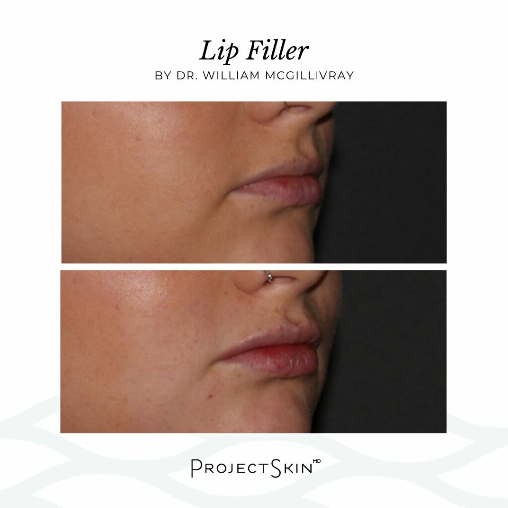 Lip Filler Before & After