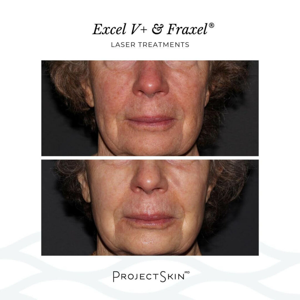 Excel V+ and Fraxel Laser Treatments