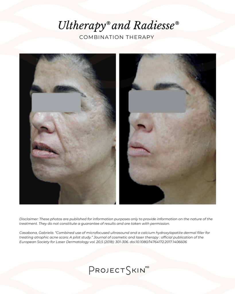 Ultherapy and Radiesse Before & After - Face