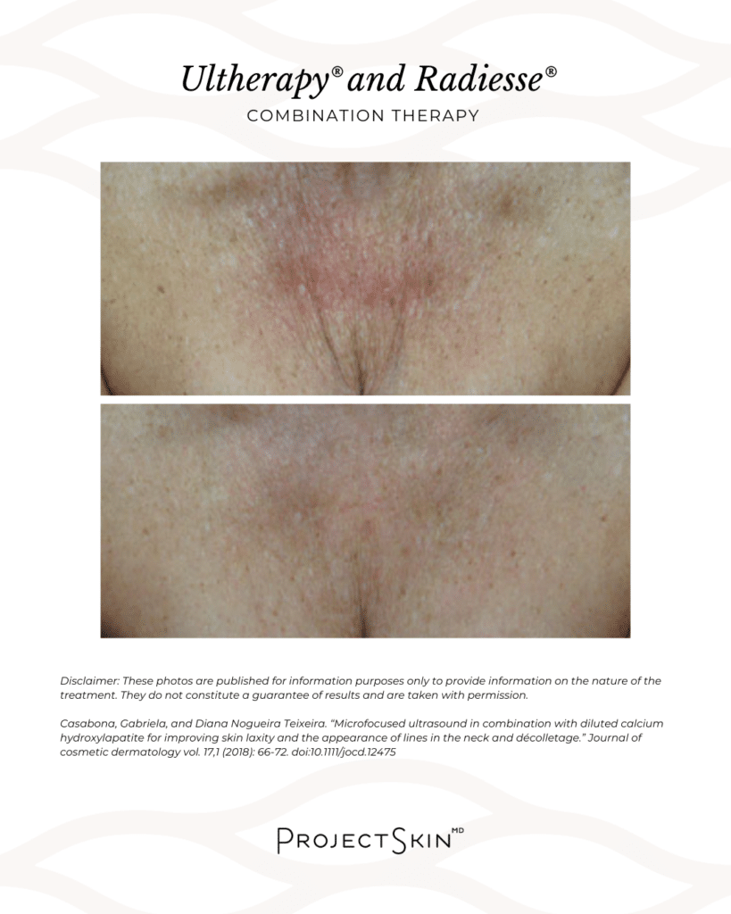 Ultherapy and Radiesse Before & After - Neck